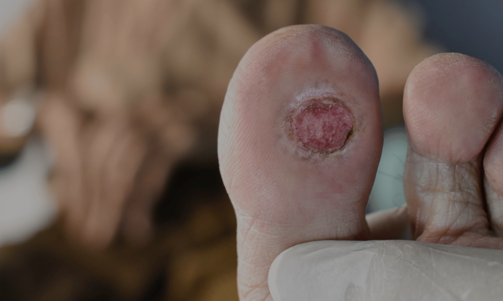 Diabetic foot ulcers online consultation