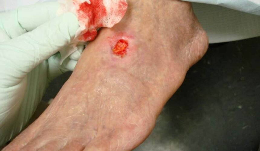 Arterial Ulcers: Causes, Symptoms, and Treatment Options