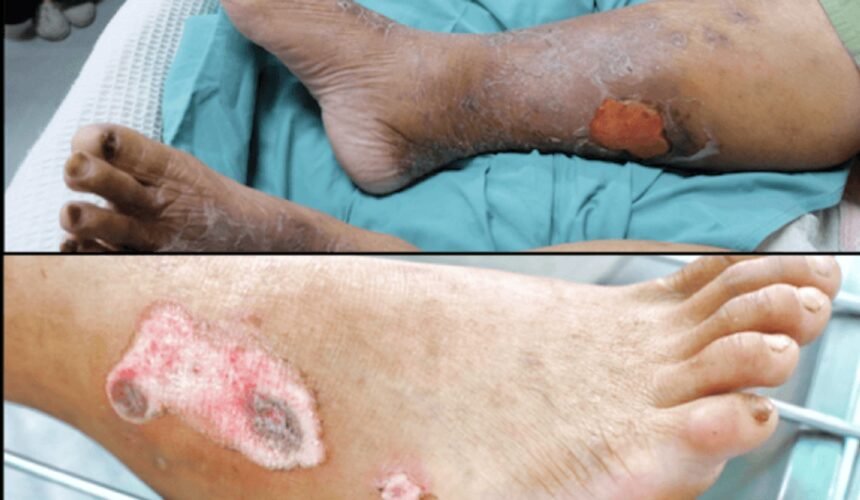 Arterial Ulcer vs venous ulcer Arterial vs. Venous Ulcers: Key Differences You Need to Know