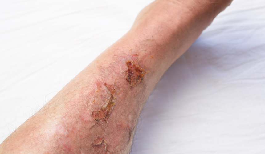 Chronic Non-Healing Wound Treatment Online Consultation