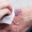 Daily Wound Care Routine to Prevent Infections