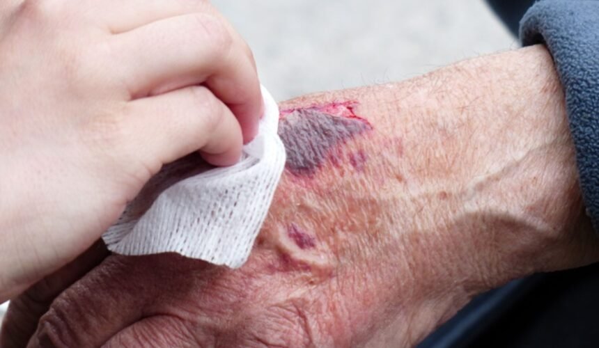 Daily Wound Care Routine to Prevent Infections
