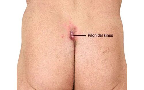 Pilonidal Sinus Causes, Symptoms and Treatment Pilonidal sinus symptoms, causes and treatment near the tailbone