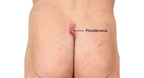 Pilonidal sinus symptoms, causes and treatment near the tailbone