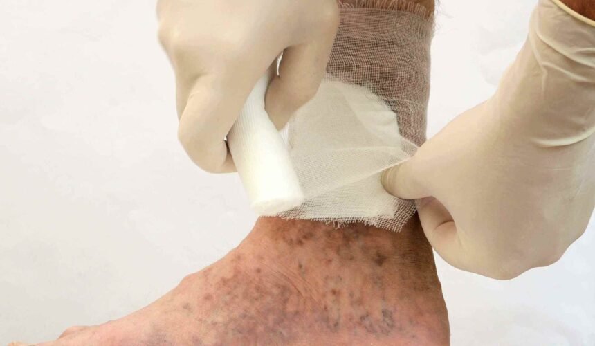Risk Factors for Arterial Ulcers and How to Reduce Them