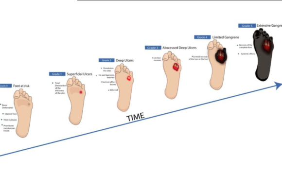 Stages of Diabetic Foot Ulcers
