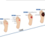 Stages of Diabetic Foot Ulcers
