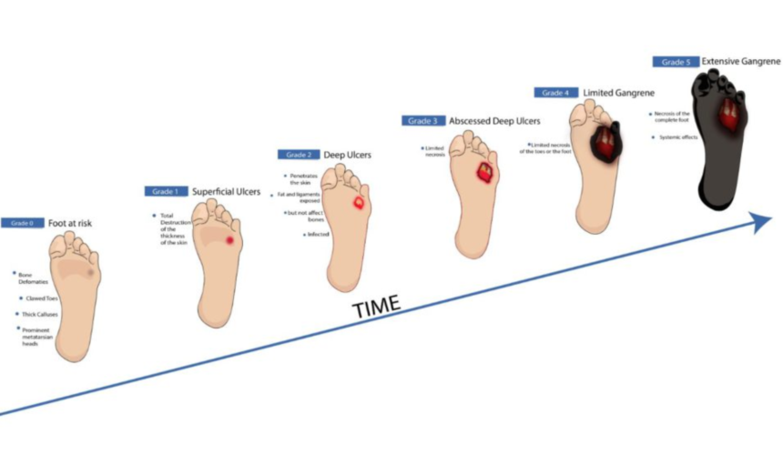 Stages of Diabetic Foot Ulcers How to Identify and Treat Them Early Stages of Diabetic Foot Ulcers