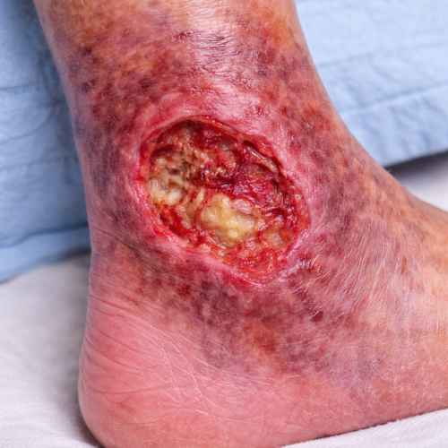 Venous Ulcer Uncovered: Why These Leg Wounds Happen and How to Heal Them for Good