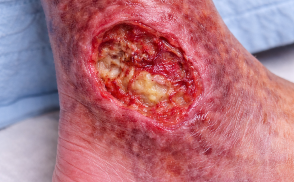 Venous Ulcer Uncovered: Why These Leg Wounds Happen and How to Heal Them for Good