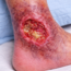 Venous Ulcer Uncovered: Why These Leg Wounds Happen and How to Heal Them for Good