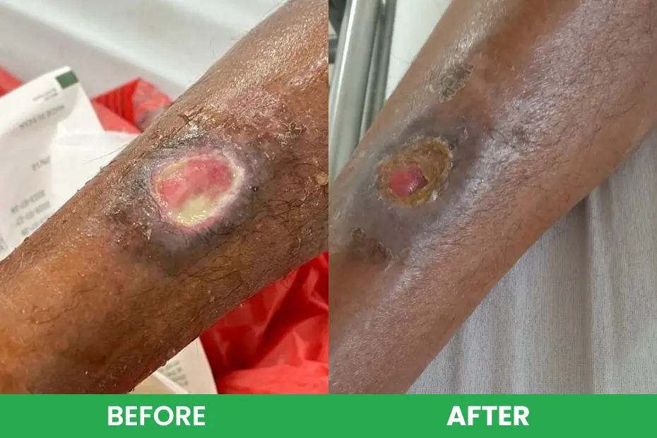 Venous ulcer Before vs After