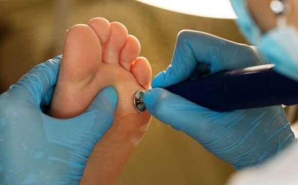 What Are Diabetic Foot Ulcers? Causes, Symptoms, and Treatment