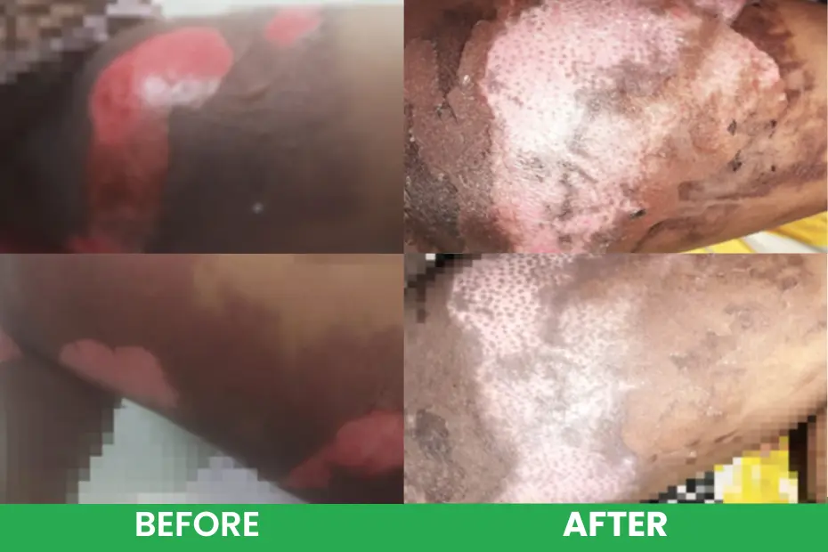 Scald Burns Before versus after treatment