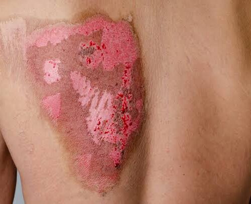 Scald Burns First Aid, Treatment and Prevention Scald burns on skin showing symptoms, first aid and wound treatment