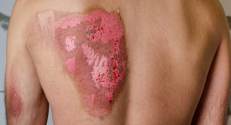 Scald Burns First Aid, Treatment and Prevention Scald burns on skin showing symptoms, first aid and wound treatment