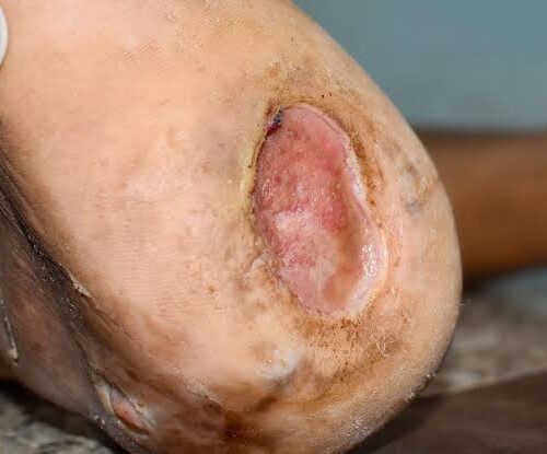 Pressure Ulcers: Causes, Stages, Risk Factors & Prevention Pressure Ulcers on the skin showing different stages of tissue damage