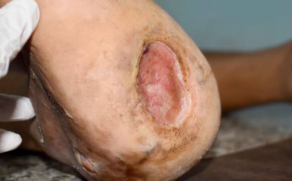 Pressure Ulcers on the skin showing different stages of tissue damage