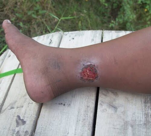 Venous Ulcer Causes, Symptoms and Treatment Venous ulcer on lower leg showing symptoms and wound care treatment