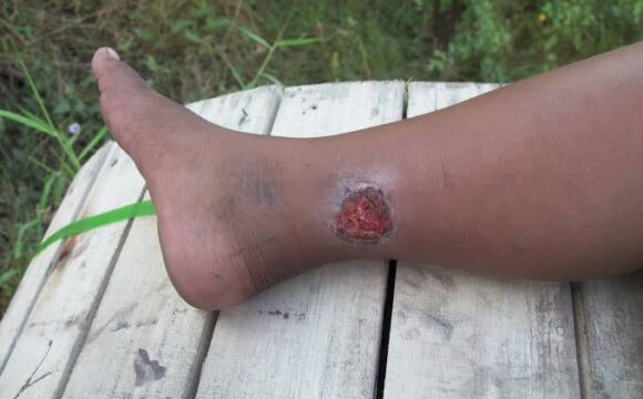 Venous ulcer on lower leg showing symptoms and wound care treatment