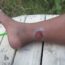 Venous ulcer on lower leg showing symptoms and wound care treatment
