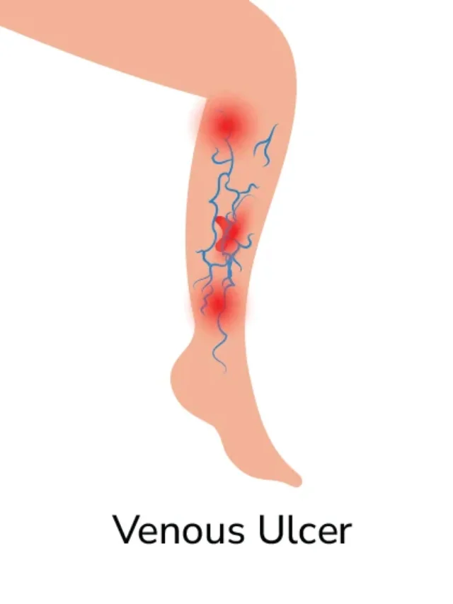 Understanding Venous Leg Ulcers: Causes & Treatments