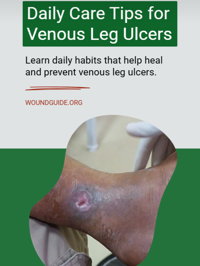 Daily Care Tips for Venous Leg Ulcers