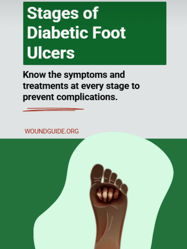Stages of Diabetic Foot Ulcers & Treatment Guide