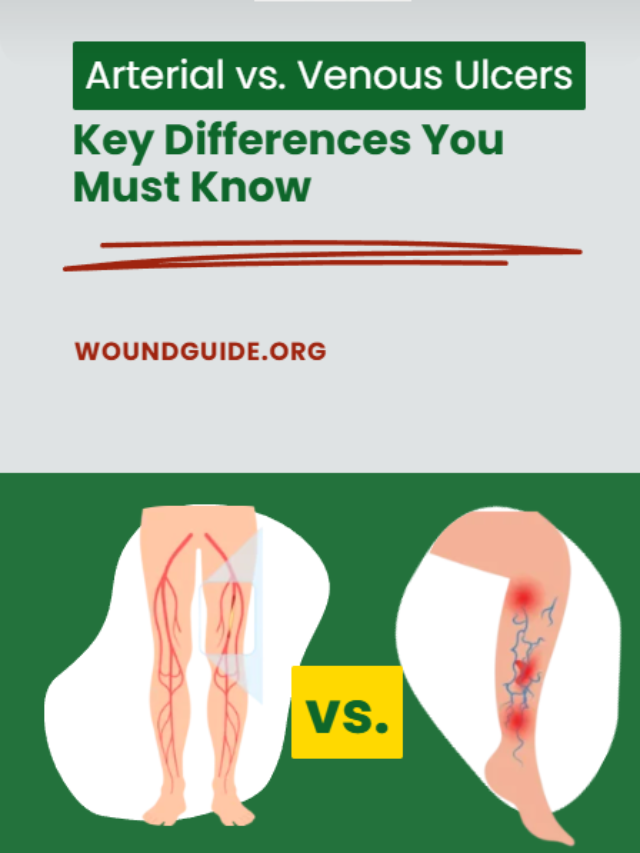 Arterial Ulcer vs Venous Ulcer: Key Differences, Symptoms & Treatment