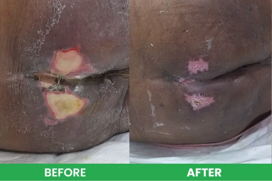 Bedsore before versus after case study