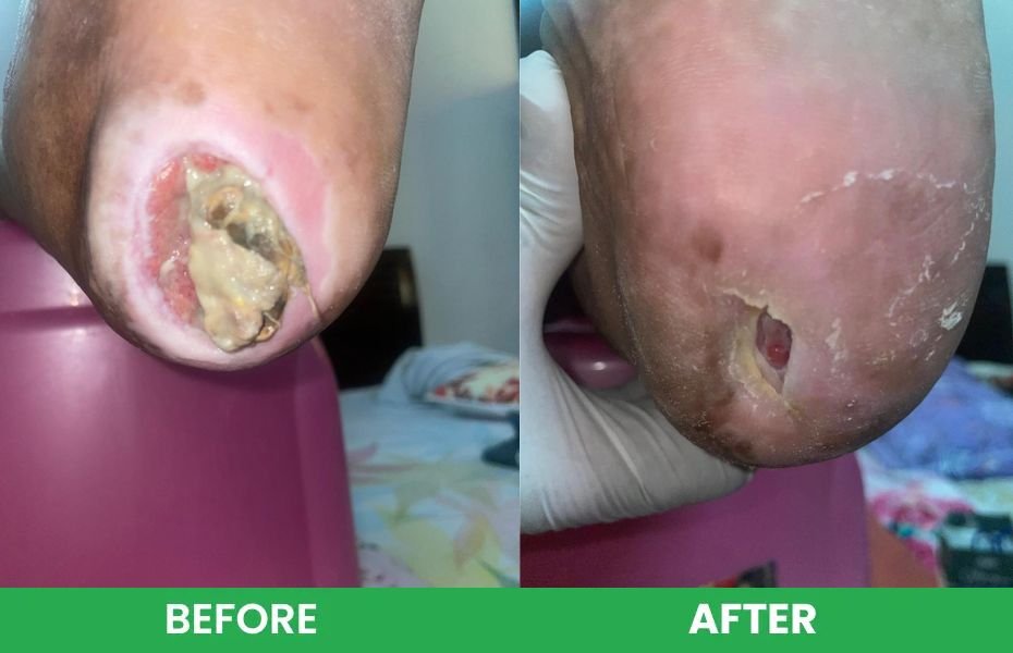 Pressure ulcer before versus after case study