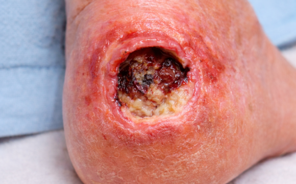 Pressure Ulcer (Foot): Causes, Stages, Treatment, and Prevention (Based on Wound Care Guidelines)