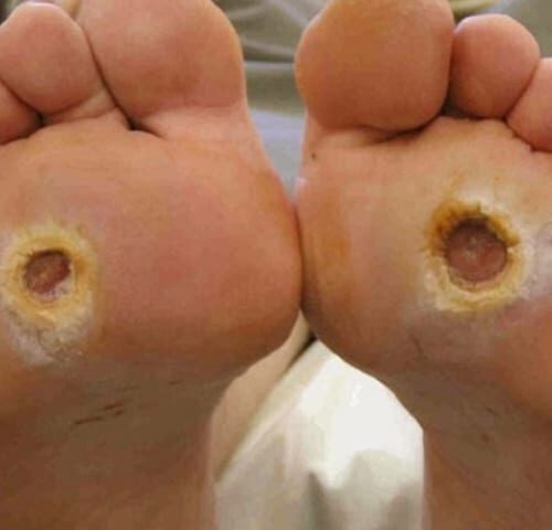 Pressure Ulcer ā Causes, Symptoms and Wound Care Pressure ulcer on skin showing tissue damage and wound severity