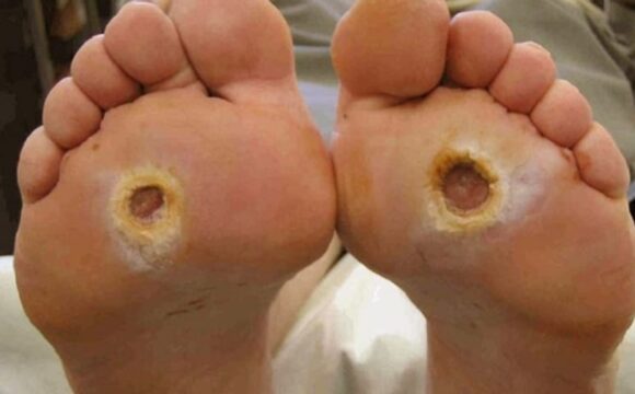Pressure ulcer on skin showing tissue damage and wound severity