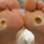 Pressure ulcer on skin showing tissue damage and wound severity