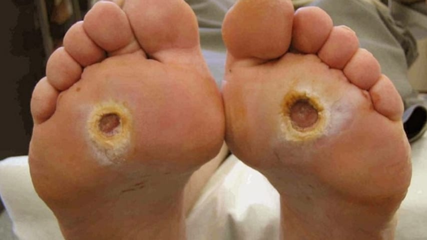 Pressure Ulcer ā Causes, Symptoms and Wound Care Pressure ulcer on skin showing tissue damage and wound severity