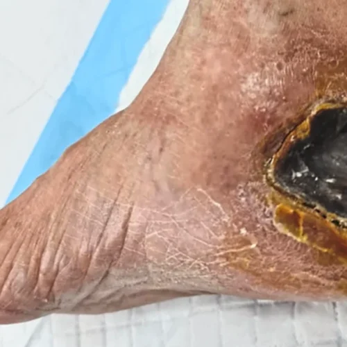 Diabetic Foot Ulcers and Bedsores Treatment in India Diabetic foot ulcers and bedsores wound care and treatment