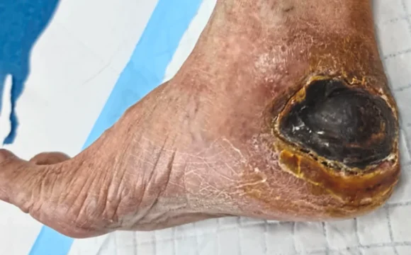 Diabetic foot ulcers and bedsores wound care and treatment