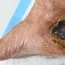 Diabetic foot ulcers and bedsores wound care and treatment