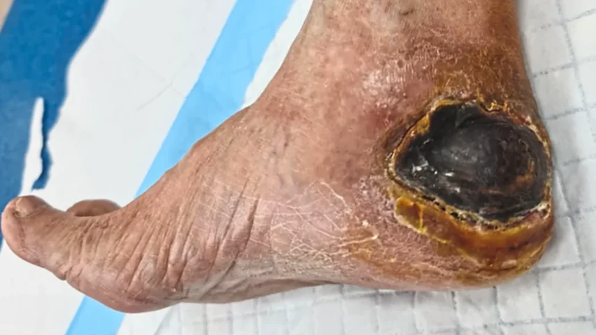 Diabetic Foot Ulcers and Bedsores Treatment in India Diabetic foot ulcers and bedsores wound care and treatment