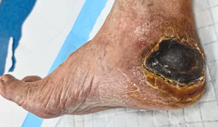 Diabetic Foot Ulcers and Bedsores Treatment in India Diabetic foot ulcers and bedsores wound care and treatment