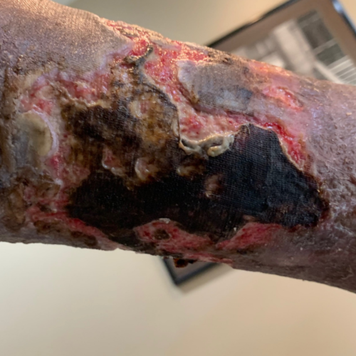 Wound debridement types for removing dead and damaged tissue