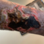 Wound debridement types for removing dead and damaged tissue