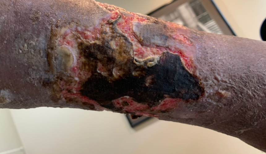 Wound debridement types for removing dead and damaged tissue