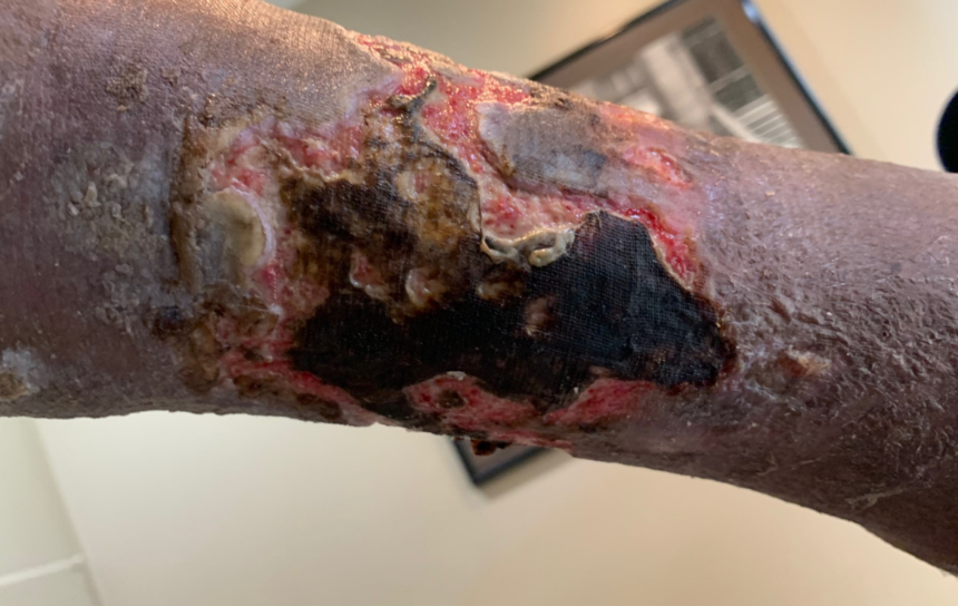 Wound Debridement Types Wound debridement types for removing dead and damaged tissue