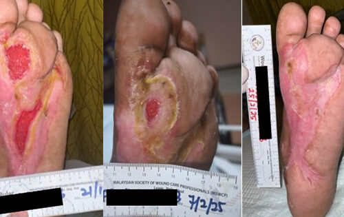 Diabetic foot stages showing progression of a diabetic foot ulcer