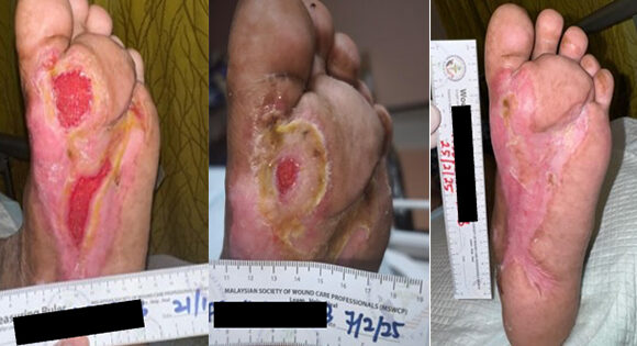 Diabetic foot stages showing progression of a diabetic foot ulcer
