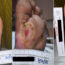 Diabetic foot stages showing progression of a diabetic foot ulcer