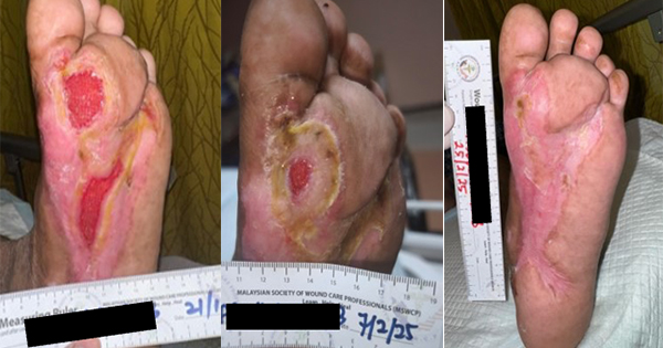 Diabetic Foot Stages and Ulcer Progression Diabetic foot stages showing progression of a diabetic foot ulcer
