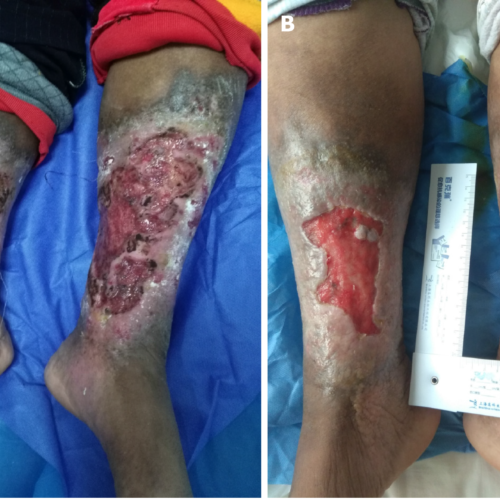 Difference between arterial and venous ulcer showing key wound characteristics